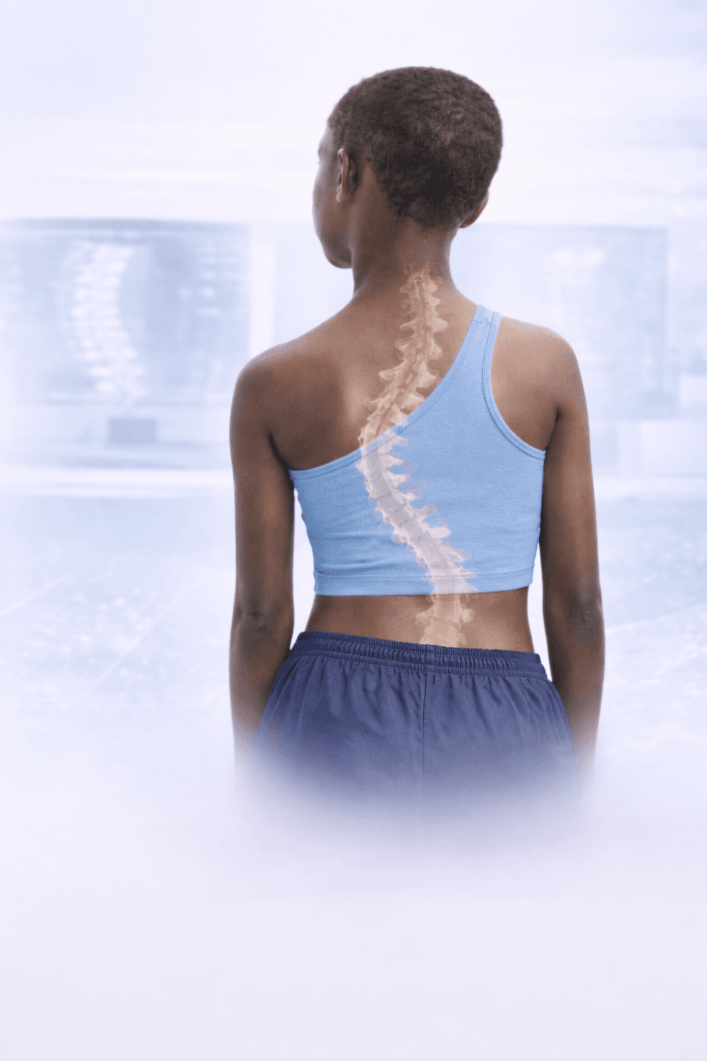 Adolescent with scoliosis spine overlay — IDONI AI screening